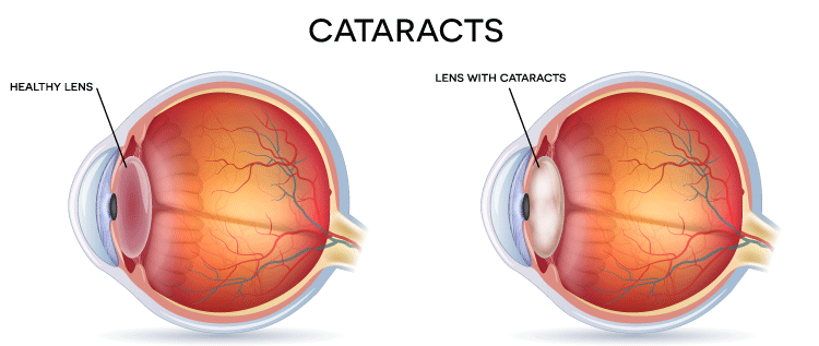Normal Eye vs Eye with Cataracts