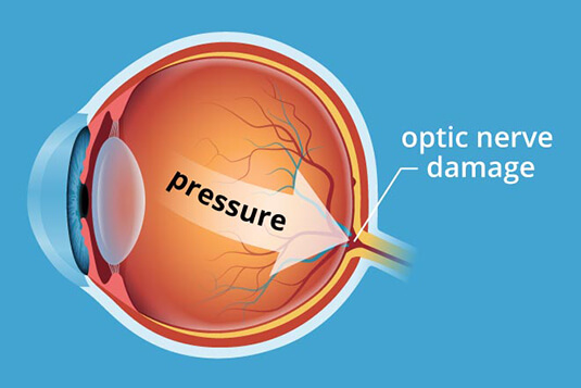 Glaucoma Pressure Diagram